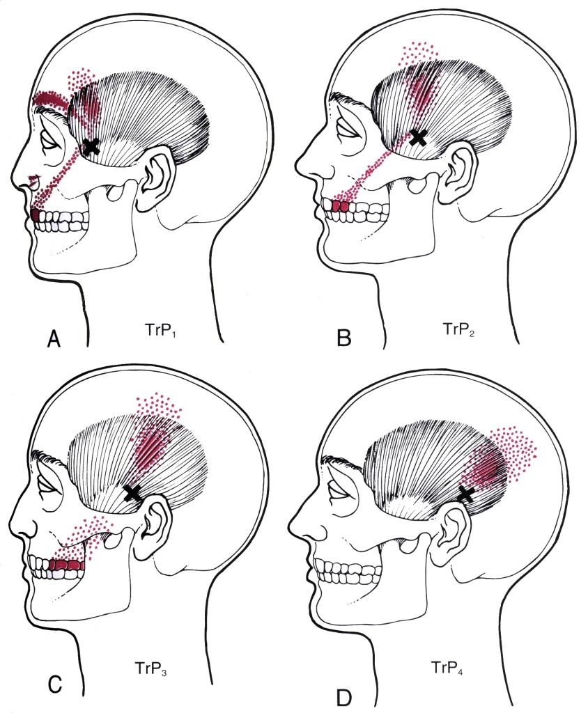 trigger pain points temporalis tmj point myofascial muscle common trp jaw tmd cause causes masseter referred head orofacial massage therapy