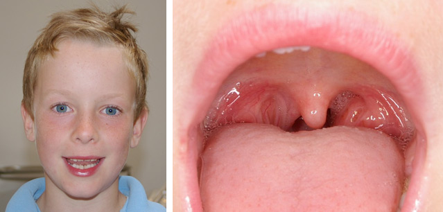 Hobart Orofacial Pain and Special Needs Clinic - mouth breathing habit resulting in an elogated face due to overcrowding and enlarged tonsils.