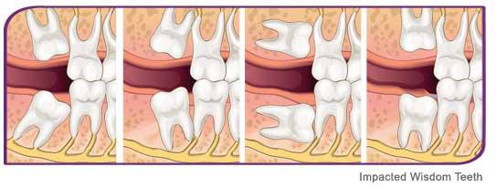 impacted wisdom teeth ache