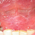 white mouth lesion