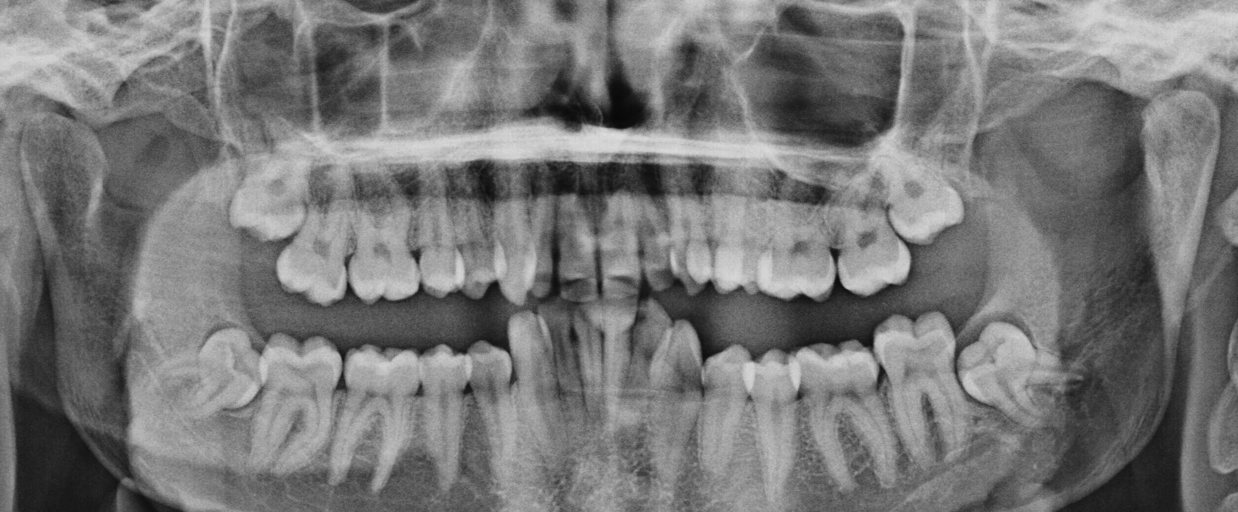 pain during wisdom tooth eruption