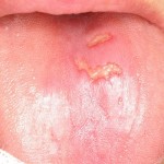tongue ulcer