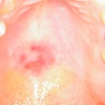 red lesion roof of mouth