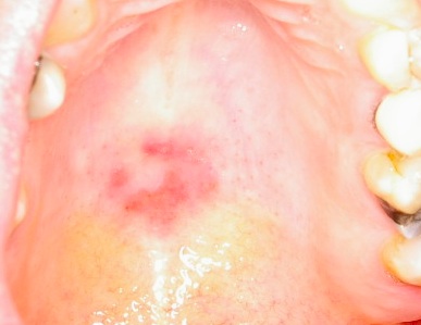 hard palate