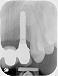 Oral surgery immediate implant extraction tooth replacement