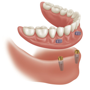 oral surgery denture implant