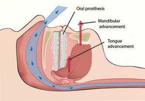 mandibular advancement device