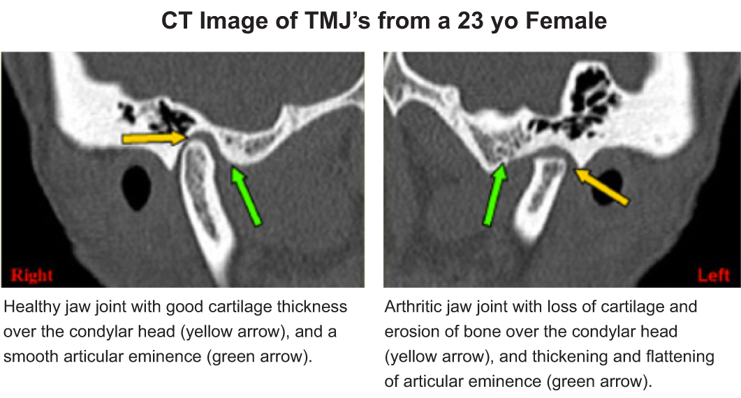 CT-Image-of-TMJ