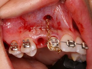 Oral surgery orthodontic canine exposure extraction