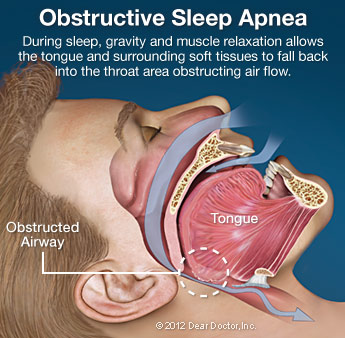 snoring sleep apnoea headaches bruxism tmj