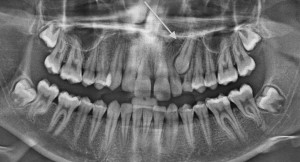 Impacted canine oral surgery orthodontics