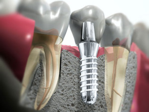 Oral surgery implant tooth replacement