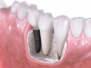 Implant Tooth replacement oral surgery