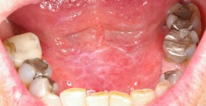 white mouth lesion