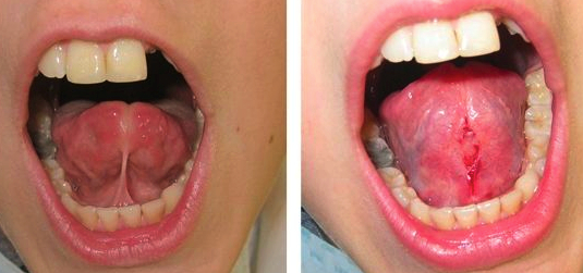 Tongue tie oral surgery