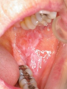 mouth fungal infection