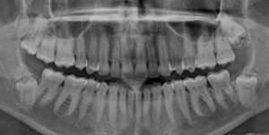Oral surgery impacted wisdom tooth extraction