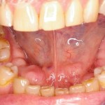 jaw bone lumps oral surgery