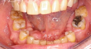jaw bone lumps oral surgery