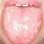 Tongue Scalloping from Bruxism