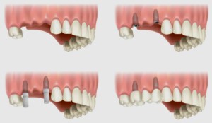 implants oral surgery