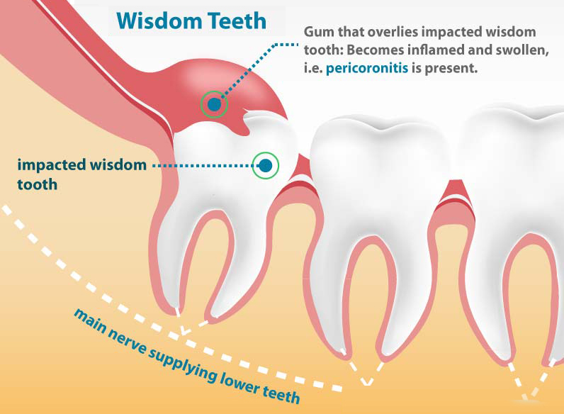 Hobart Orofacial Pain and Special Needs Clinic Wisdom Teeth Pain Cause - Pericoronitis
