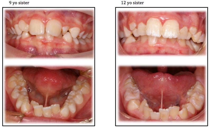 Images show almost identical dental malocclusions (crowding) on two sisters aged 9 and 12 as a result of untreated tongue tie